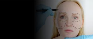 Deep Plane Facelift vs Traditional Facelift