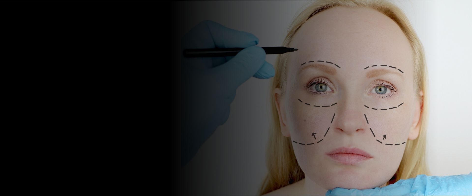 Deep Plane Facelift vs Traditional Facelift