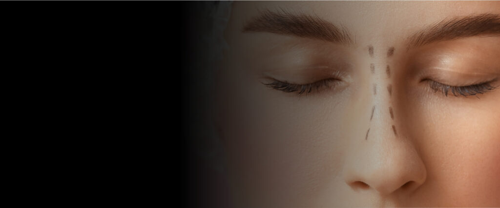 Open vs Closed Rhinoplasty